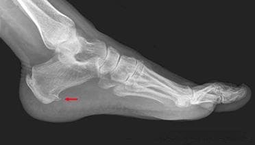 引起足跟痛的4种足部疾病