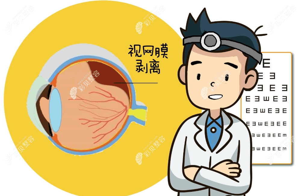 视网膜脱离的主要原因,症状,治疗方法及手术费用一文说清