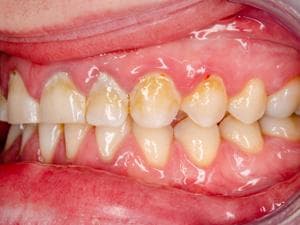 牙菌斑由什么组成？如何预防和清除？