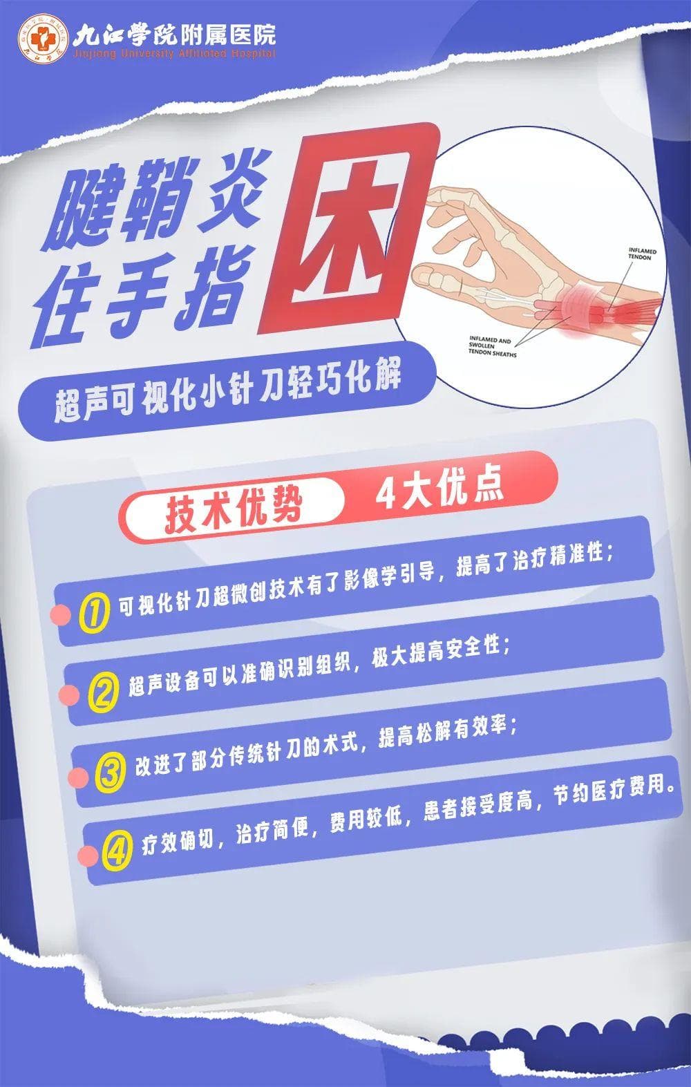 九江学院附属医院科普 ：腱鞘炎“困”住手指  超声可视化小针刀轻巧化解