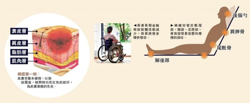 中医内外兼治褥疮