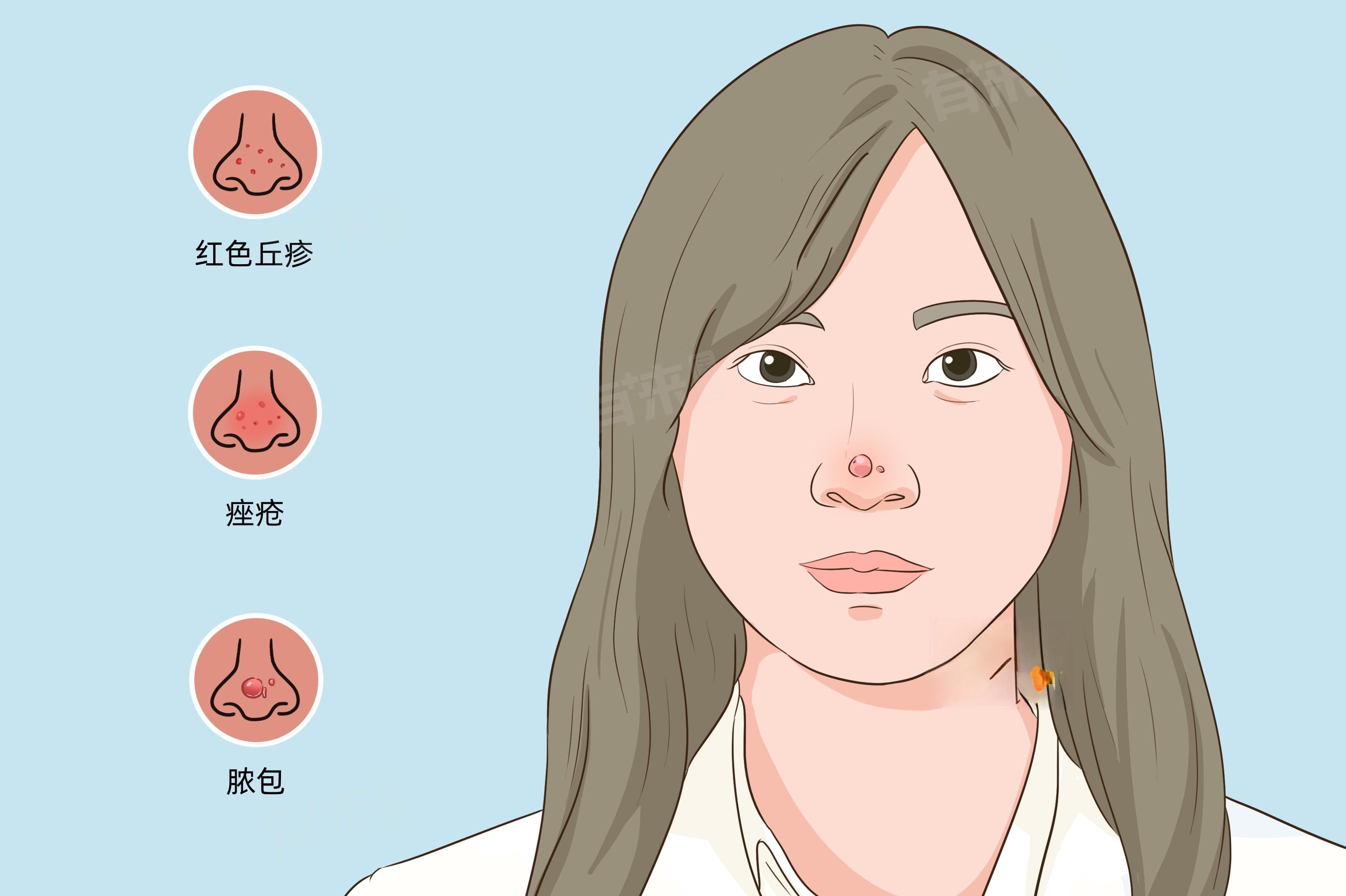 鼻子上和周围长痘痘是什么原因