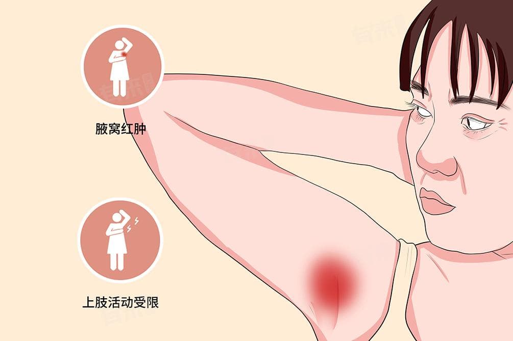 腋下痛的五大原因及应对方法