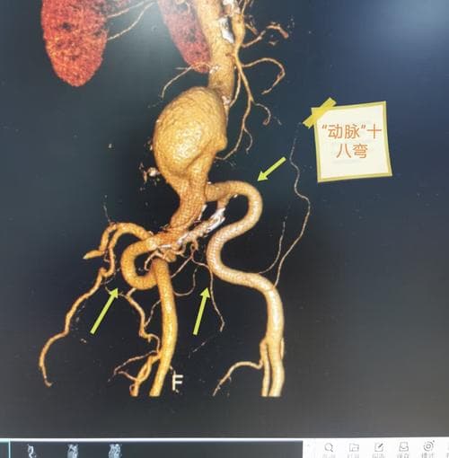 腹部大动脉瘤：全面了解与防治