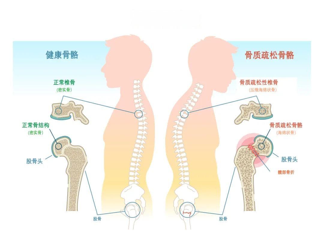 合肥京东方医院：骨质疏松可防可治
