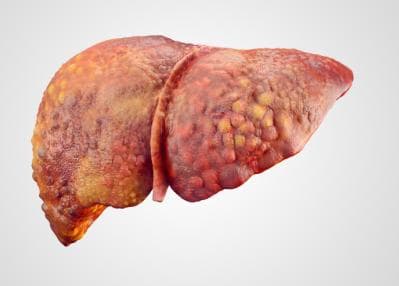 肝硬化患者这样护理：饮食生活心理监测全指南