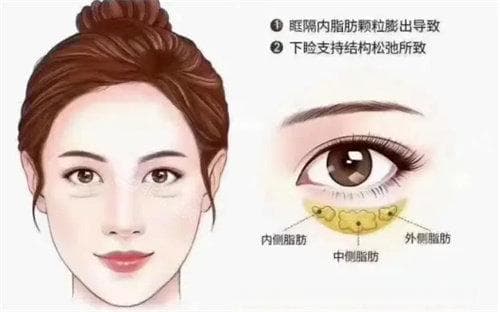 去眼袋是动手术好还是微创好？微创与传统手术的选择！