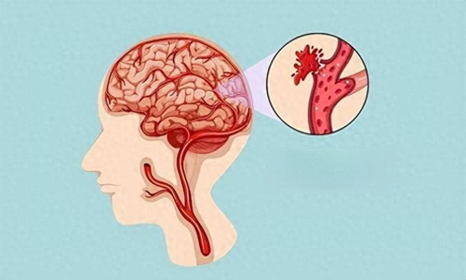 为何脑出血“年轻化”趋势？年轻人如何早期预防？
