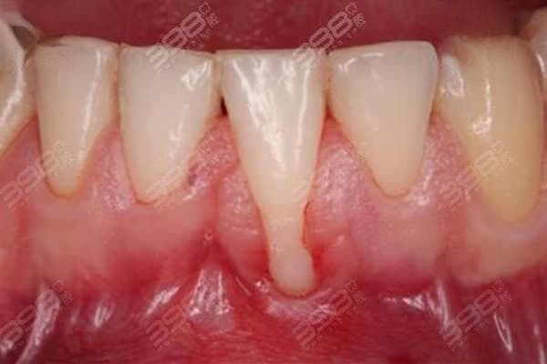 牙龈萎缩怎么挽救？来看这几种方法是牙龈萎缩的较佳治疗方法