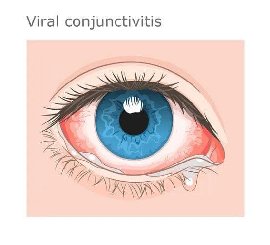 了解儿童常见眼病——结膜炎
