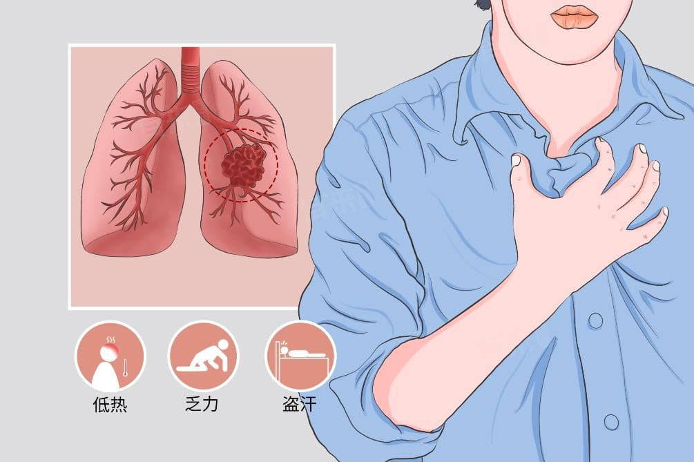 肺结核早期的5个信号