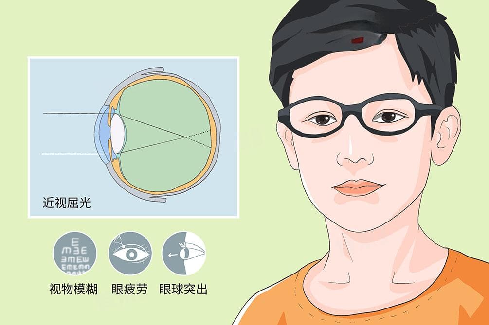 有散光可以做近视激光手术吗？