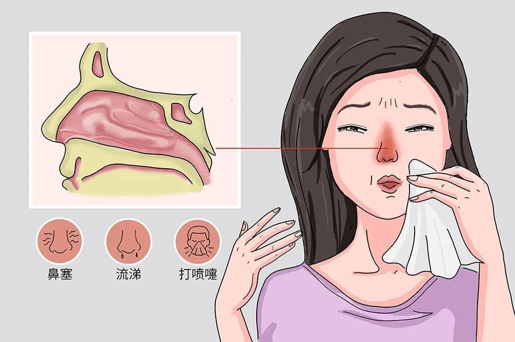 鼻炎引起心肌供血不足