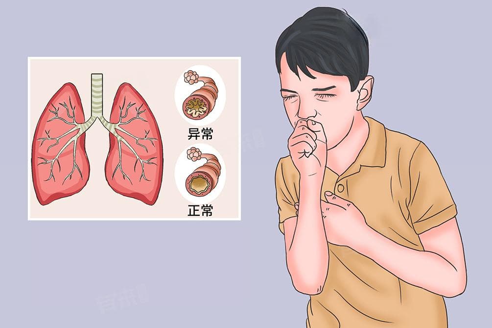 过敏性气管炎怎么治才能彻底除根