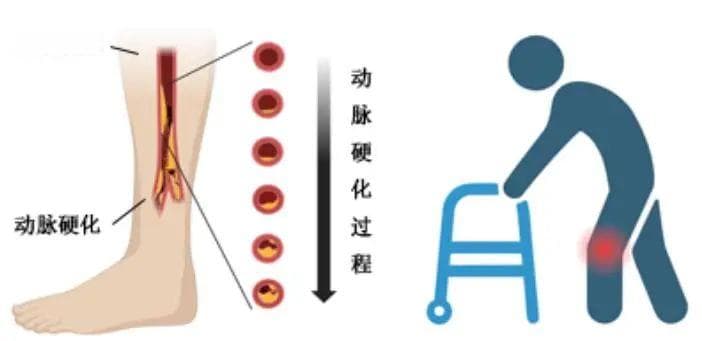 腿冷、发麻、走不远，原来是“腿梗”