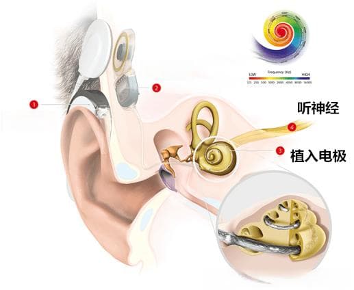 人工耳蜗（双模干预）首次佩戴康复指南