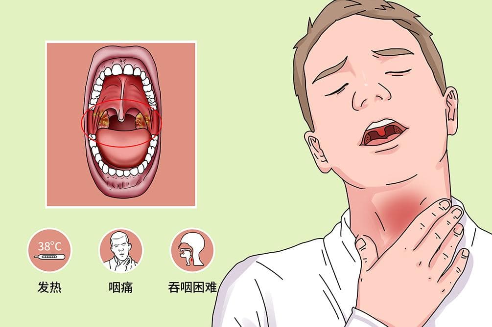 怎么知道自己扁桃体肥大
