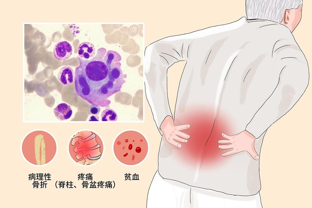 骨髓瘤：症状、诊断与治疗全解析