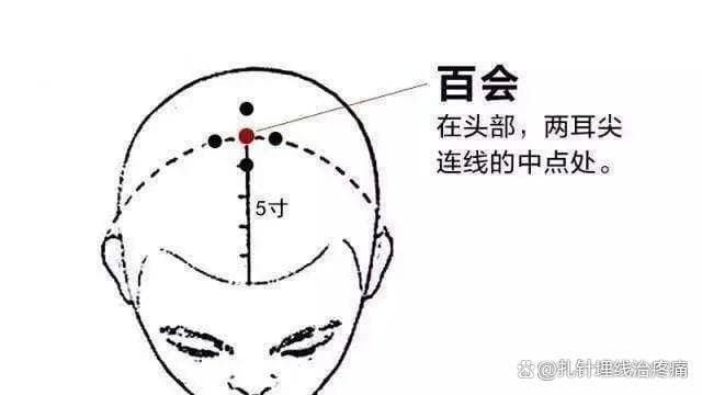 石学敏临床常用腧穴之百会穴