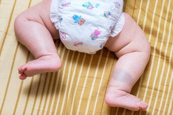 肠套叠幼儿症状及处理方法