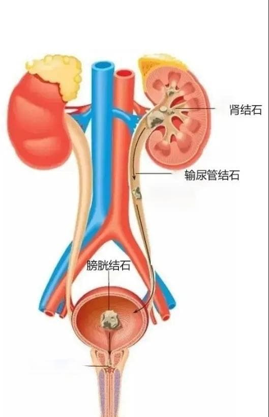 职场人防肾结石秘籍：水+柠檬+高纤
