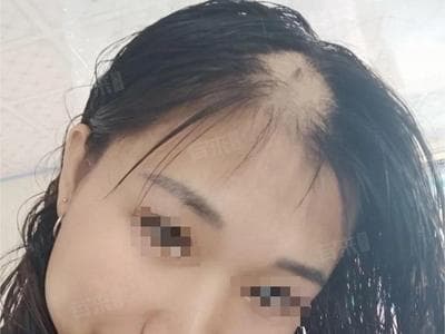 秃顶是怎么形成的