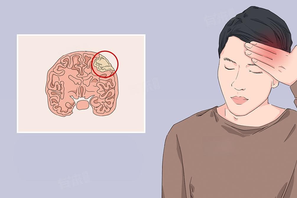 脑肿瘤是什么概念