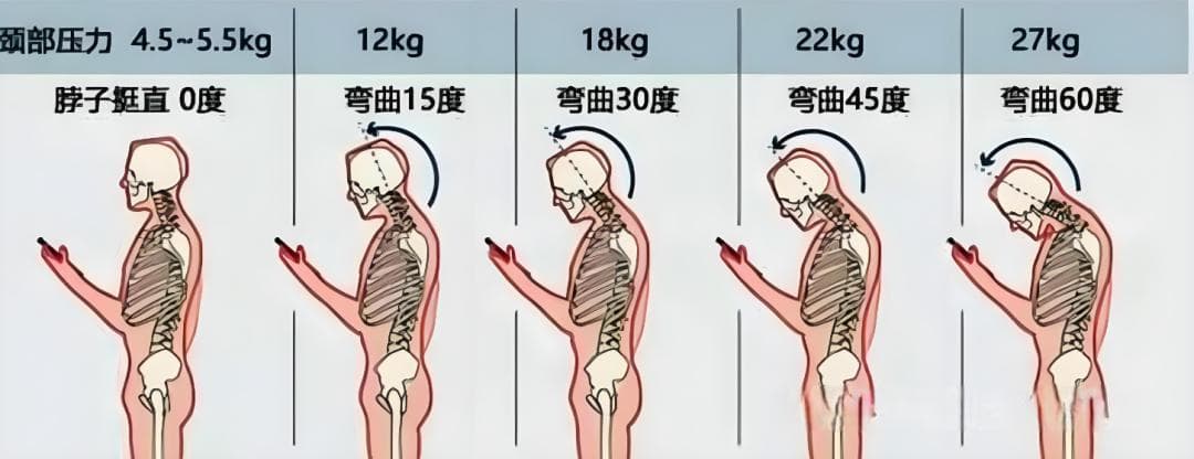 头痛或与颈椎有关，颈源性头痛这样防治