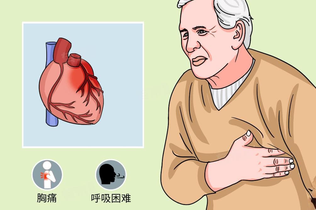 什么人容易得心梗