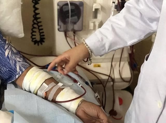 一周进行三次血液透析，生命能延续几年？肾内科医师告诉你答案