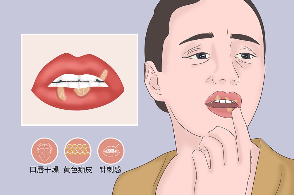 剥脱性唇炎：病因、症状与治疗全解析