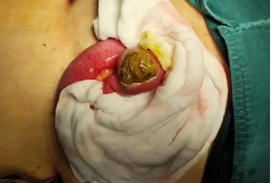 60 岁阿姨腹痛腹胀一周，原因竟是「乒乓球」大小的肠粪石！