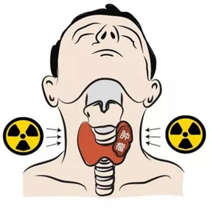 从焦虑到安心：分化型甲状腺癌术后的“碘-131治疗”解惑