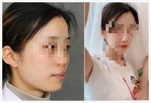 嘴巴往前外凸怎么矫正？骨性与牙性嘴凸的矫正方法与价格详解