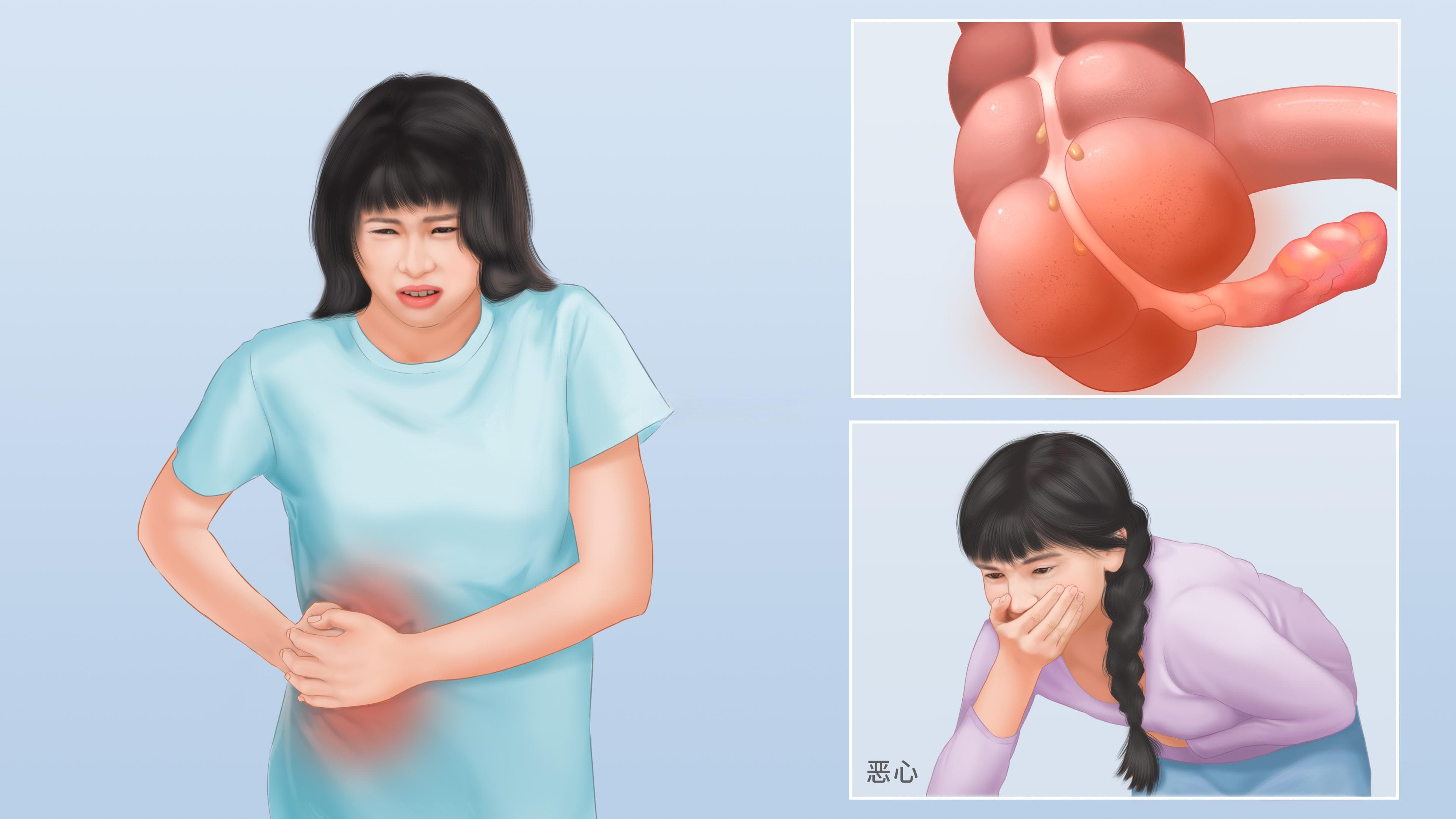盲肠炎：症状、诊断与治疗全解析
