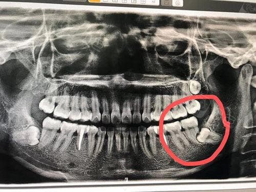 智齿被蛀空了怎么办？处理方式还要看智齿是“好”还是“坏”！