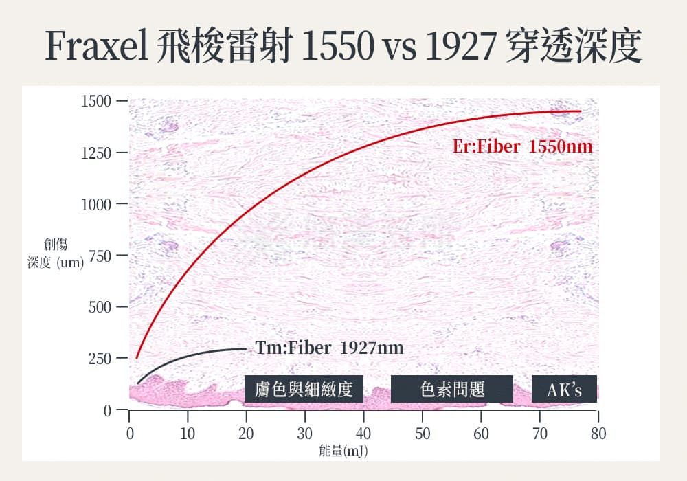 飞梭激光全攻略！缩毛孔效果好吗？要打几次？价格/术后照顾