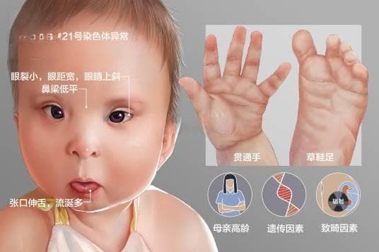 唐氏综合征：症状、治疗及预防