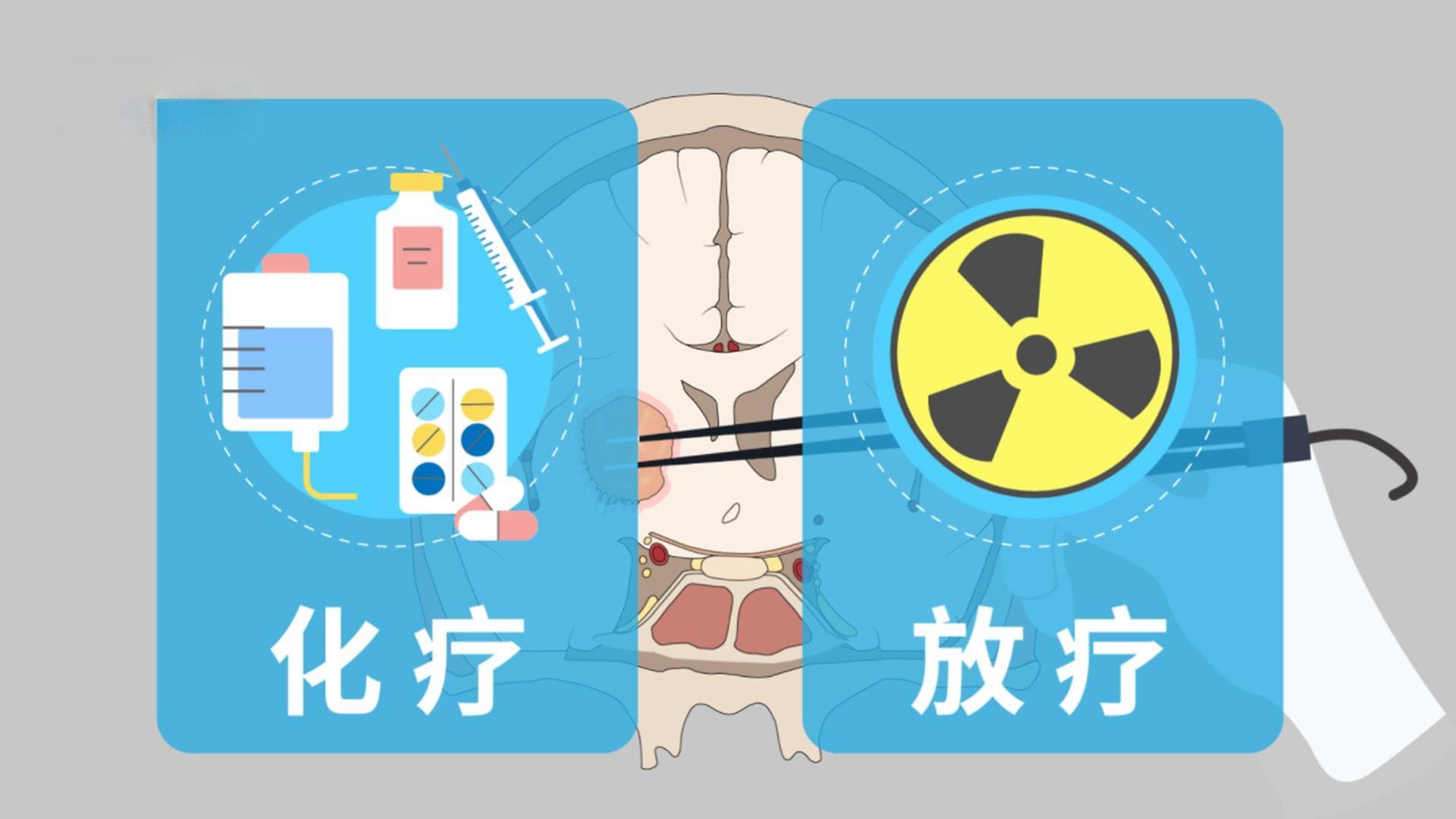 脑胶质瘤术后放疗：作用、适应证和时机全解析