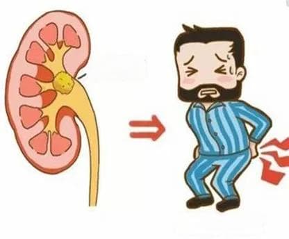 得了肾结石不做手术可以吗？听听超声科医生怎么说