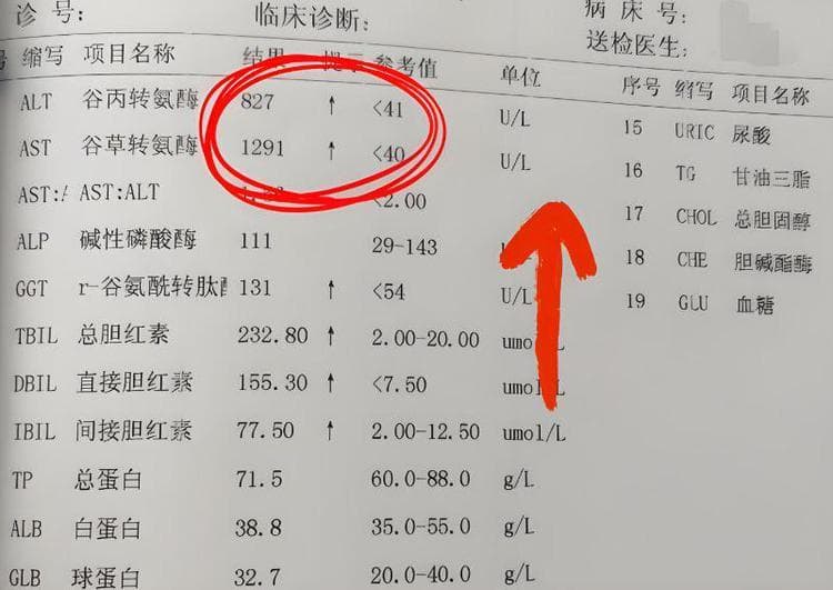 肝功能6指标异常，可能是肝硬化信号