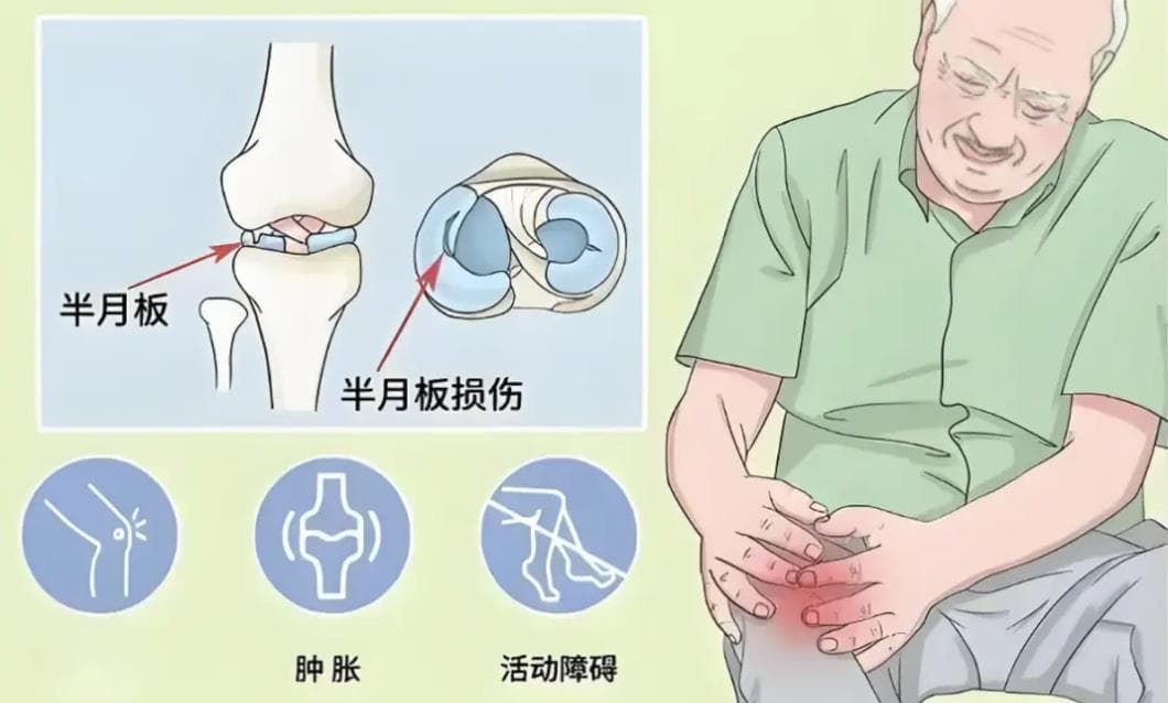 半月板损伤：膝关节的 “隐形伤痛” 与修复之道