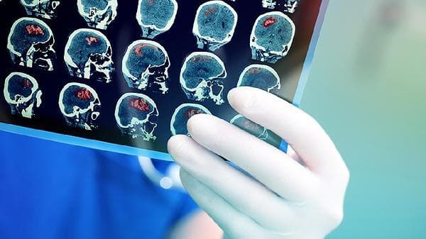 脑梗康复锻炼全攻略：三大阶段助您科学恢复