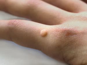 医用退热凝胶治疣吗