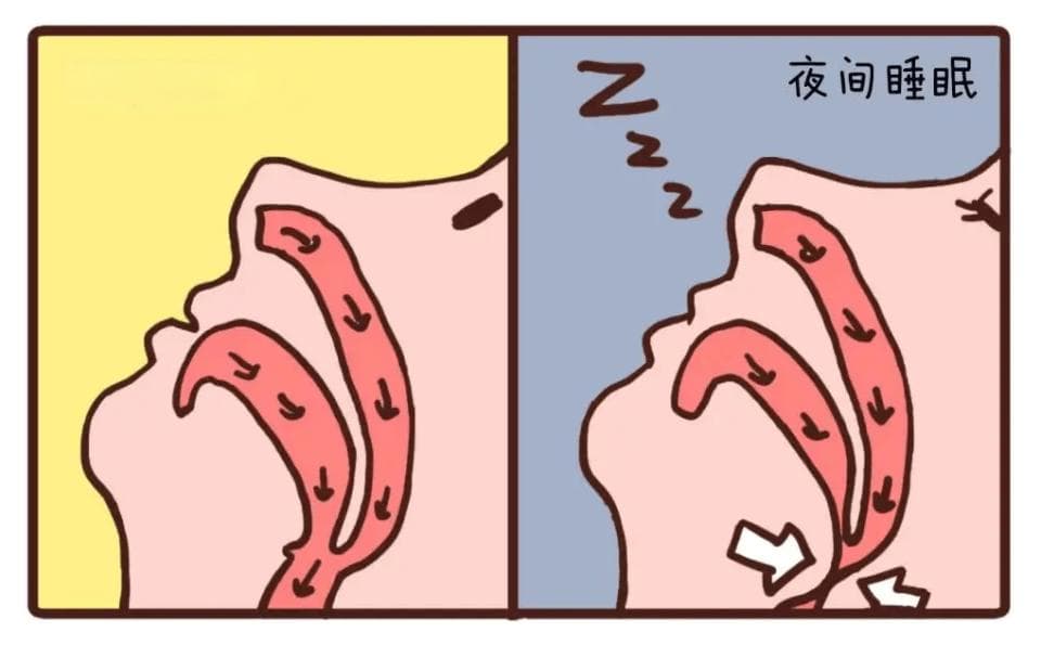 哈佛健康：睡眠呼吸暂停与心脏病，一个不可忽视的健康隐患