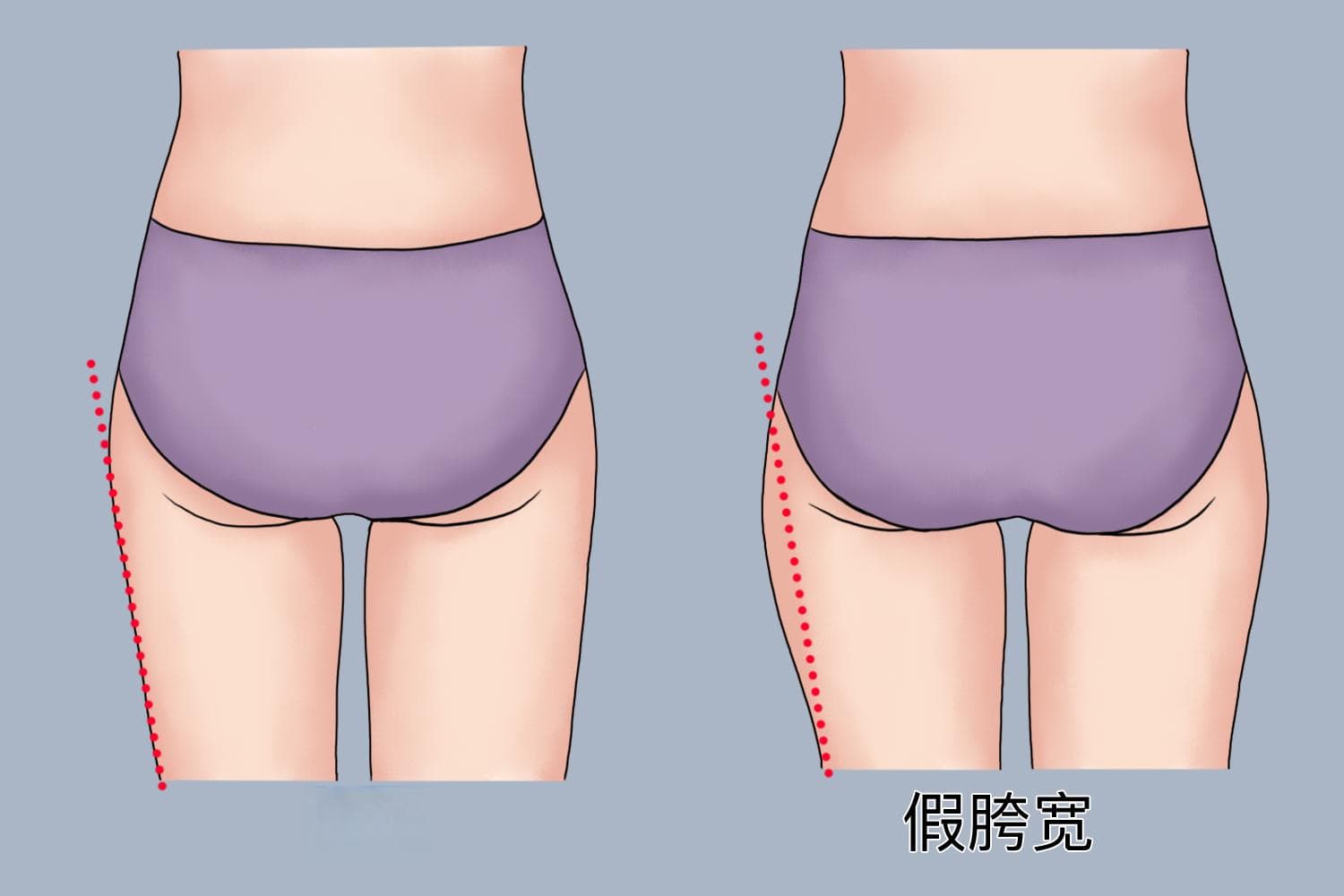 假胯宽怎么矫正