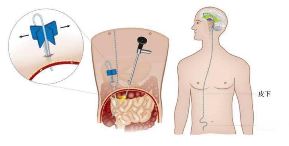 脑积水治疗利器：脑室腹腔分流术全解析