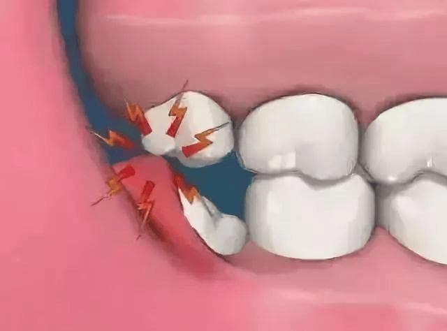 智齿拔除全解析：专家揭秘何时该拔，如何保护口腔健康！