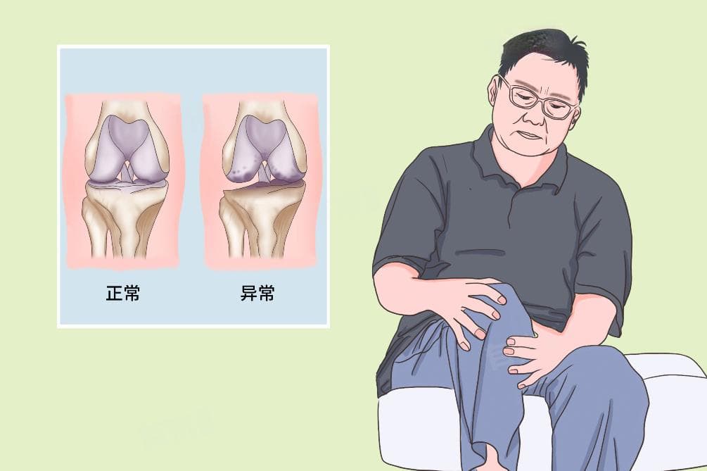 膝关节骨刺的治疗方法和注意事项