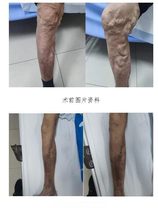 专家推荐：静脉曲张术后这样运动更安全